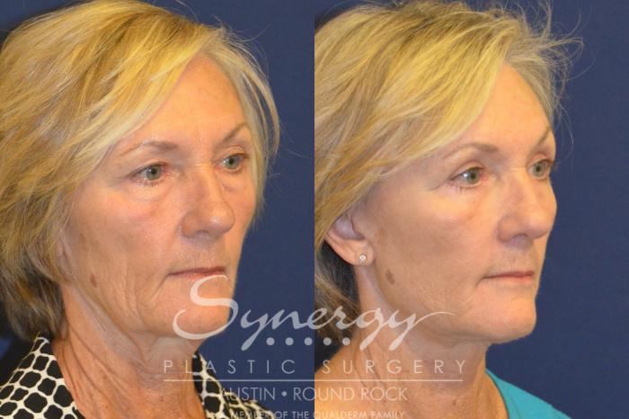 Before & After Facelift Case 367 View #3 View in Austin, TX