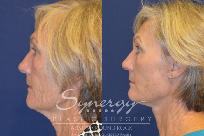 Before & After Facelift Case 367 View #4 View in Austin, TX