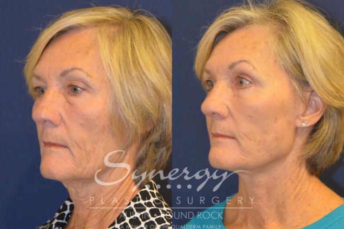 Before & After Facelift Case 367 View #5 View in Austin, TX