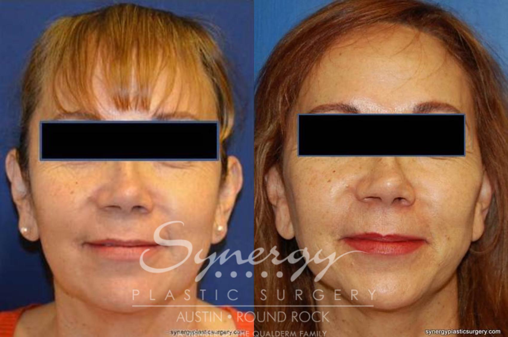 Before & After Facelift Case 371 View #1 View in Austin, TX