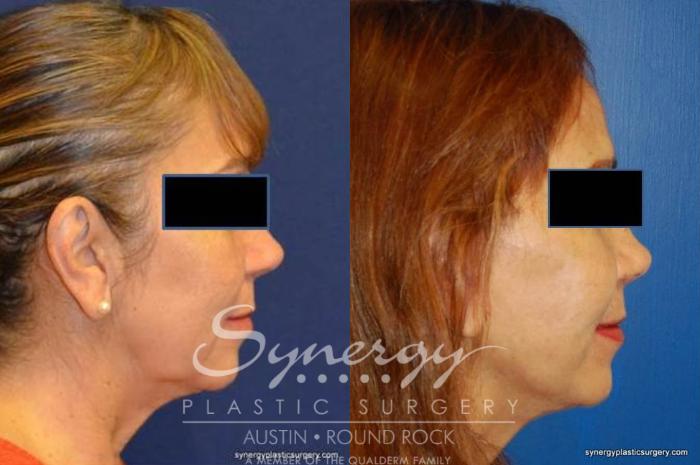 Before & After Facelift Case 371 View #2 View in Austin, TX