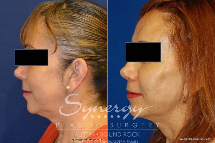 Before & After Facelift Case 371 View #4 View in Austin, TX