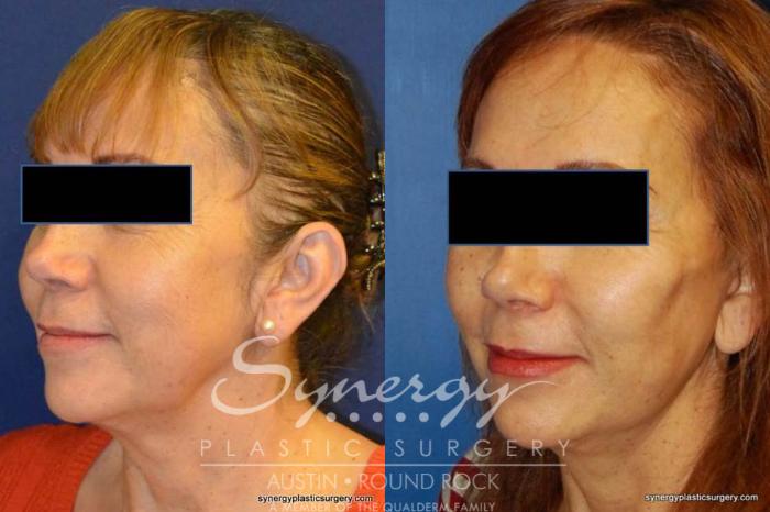 Before & After Facelift Case 371 View #5 View in Austin, TX