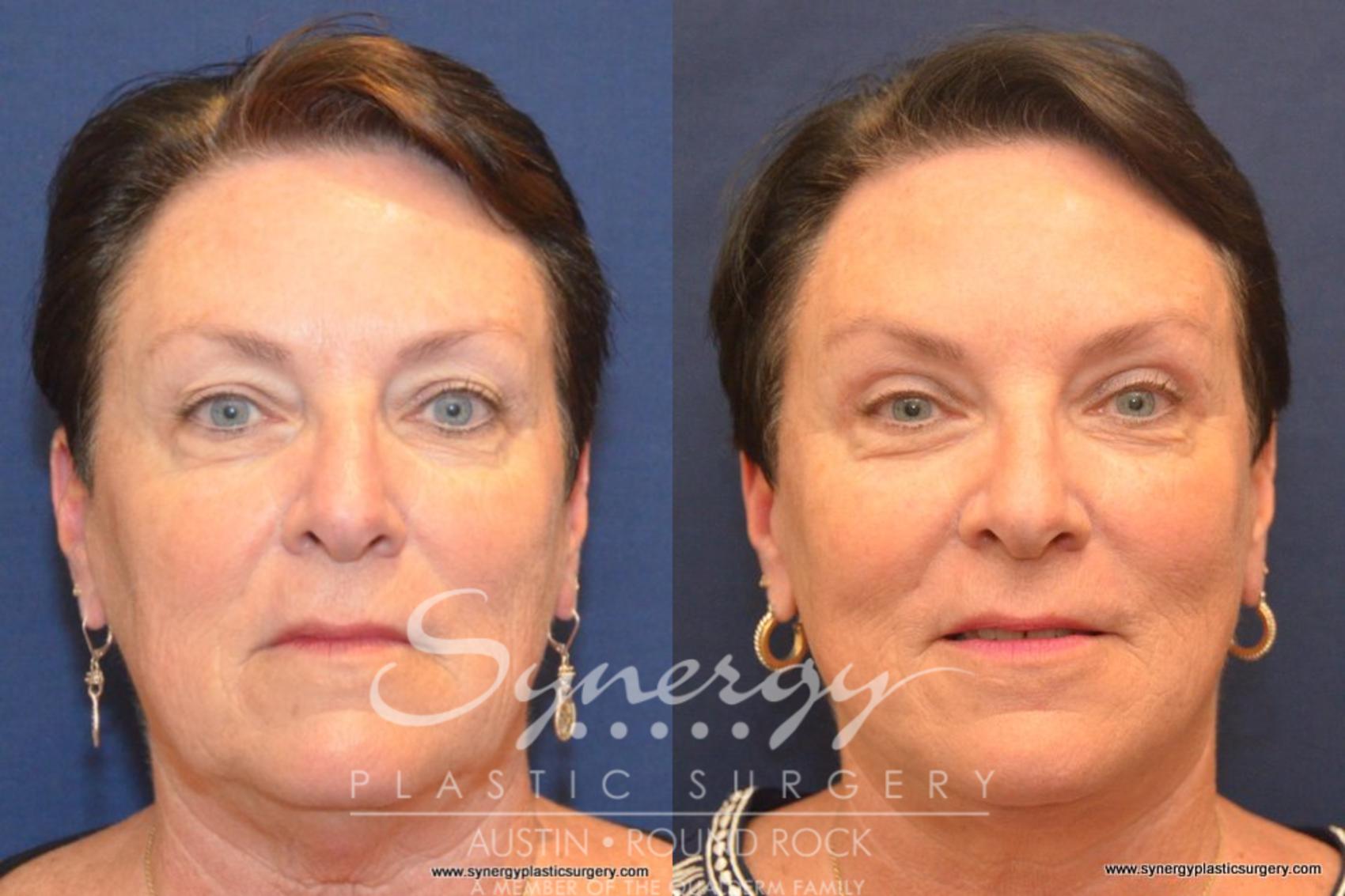 Non-Surgical Jawline Contouring Austin and Westlake