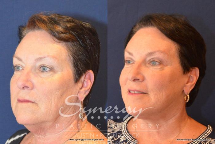 Before & After Facelift Case 406 View #3 View in Austin, TX