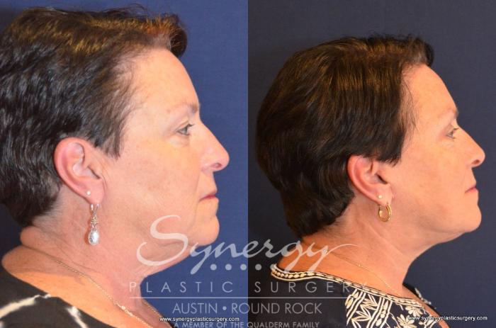 Before & After Facelift Case 406 View #4 View in Austin, TX