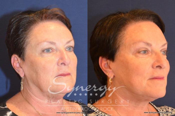 Before & After Facelift Case 406 View #5 View in Austin, TX