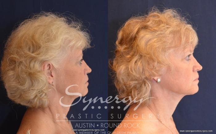 Before & After Facelift Case 498 View #2 View in Austin, TX