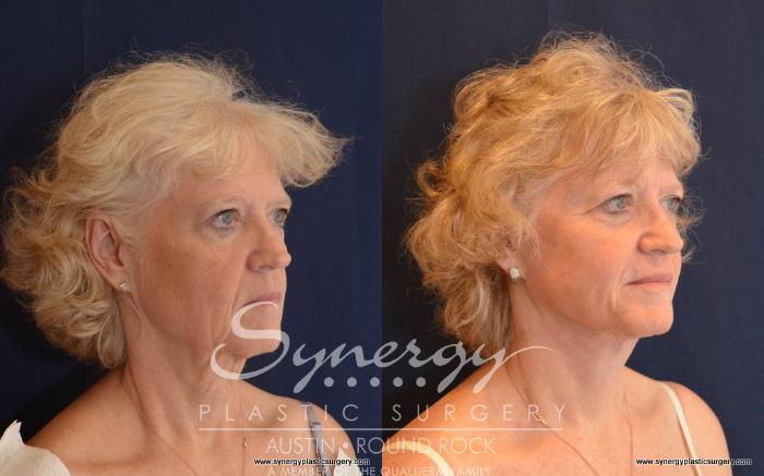 Before & After Facelift Case 498 View #3 View in Austin, TX