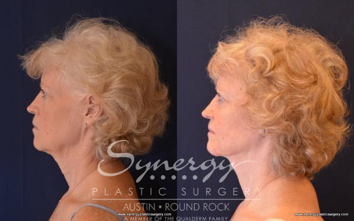 Before & After Facelift Case 498 View #4 View in Austin, TX