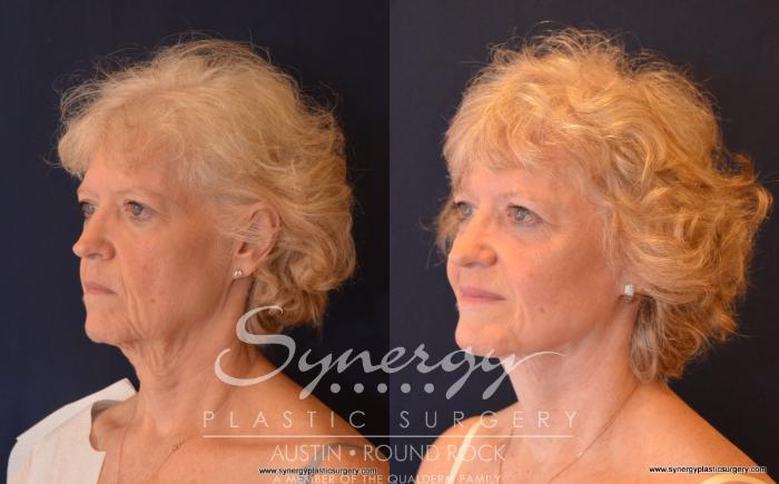 Before & After Facelift Case 498 View #5 View in Austin, TX