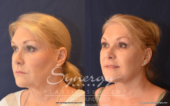 Before & After Facelift Case 526 View #2 View in Austin, TX
