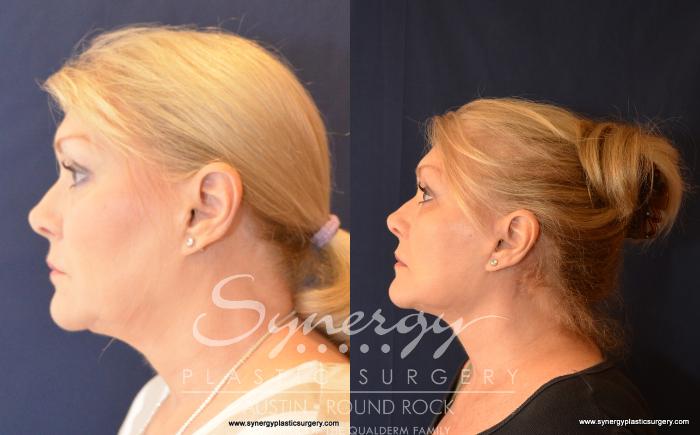 Before & After Facelift Case 526 View #3 View in Austin, TX