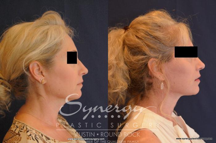 Before & After Facelift Case 566 View #3 View in Austin, TX