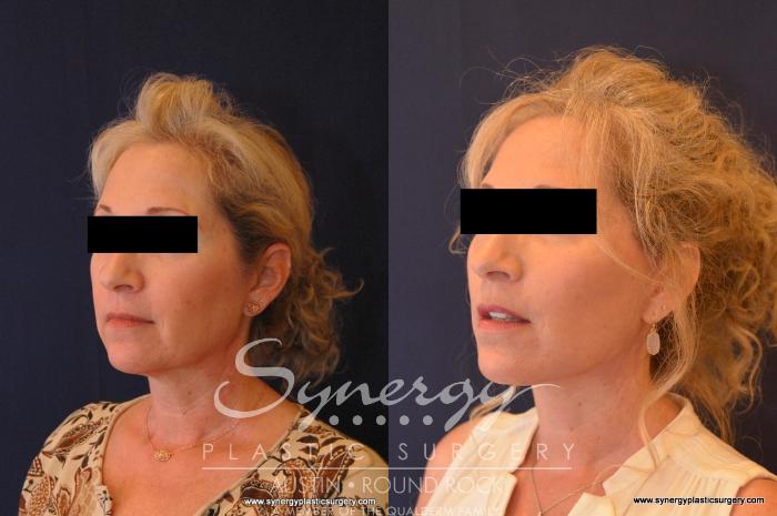 Before & After Facelift Case 566 View #4 View in Austin, TX