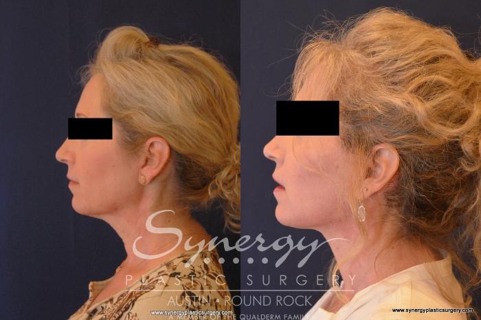 Before & After Facelift Case 566 View #5 View in Austin, TX