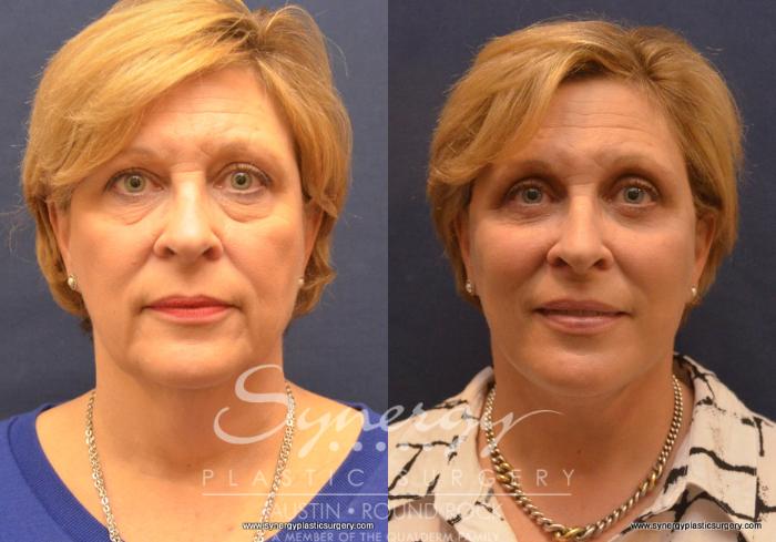 Before & After Facelift Case 658 View #1 View in Austin, TX