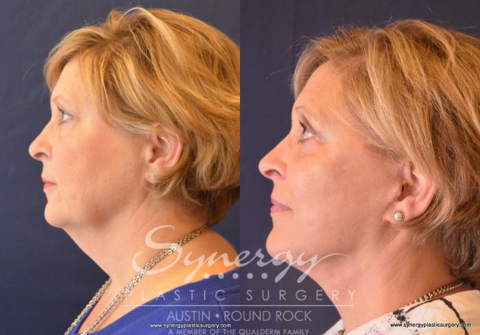 Before & After Facelift Case 658 View #3 View in Austin, TX
