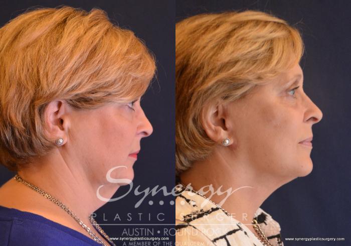 Before & After Facelift Case 658 View #4 View in Austin, TX