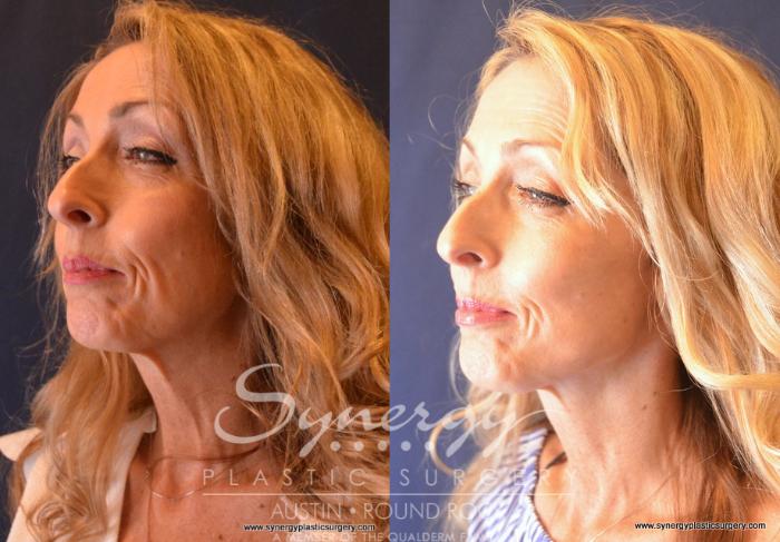 Before & After Facelift Case 680 View #1 View in Austin, TX