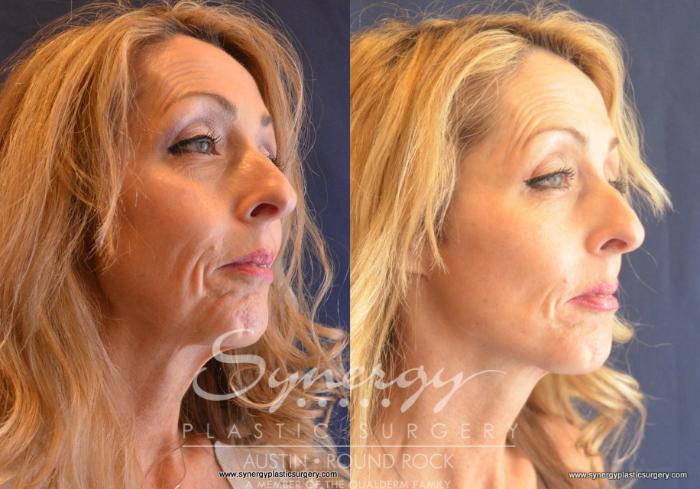 Before & After Facelift Case 680 View #2 View in Austin, TX