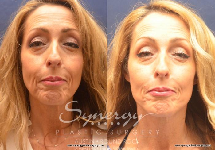 Before & After Facelift Case 680 View #4 View in Austin, TX