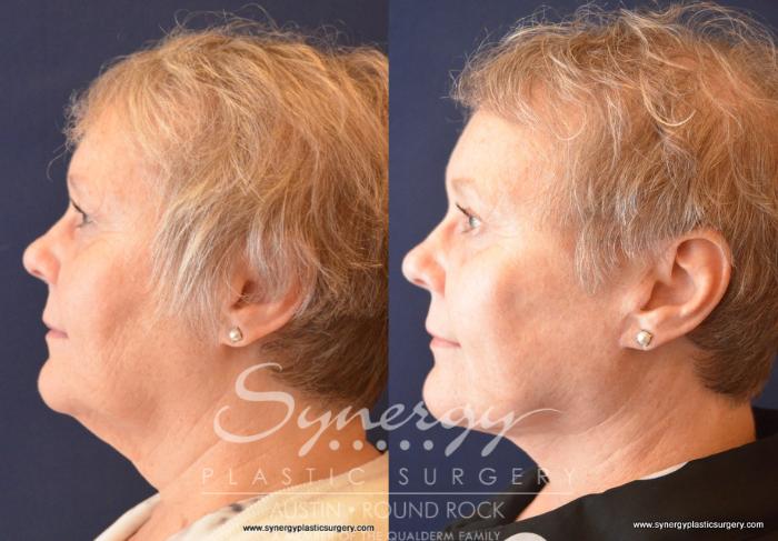 Before & After Facelift Case 688 View #2 View in Austin, TX