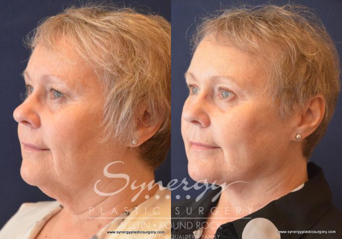 Before & After Facelift Case 688 View #3 View in Austin, TX