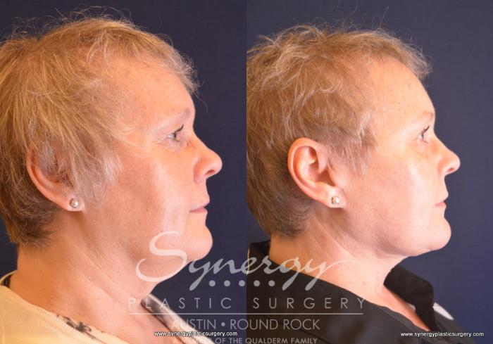 Before & After Facelift Case 688 View #4 View in Austin, TX