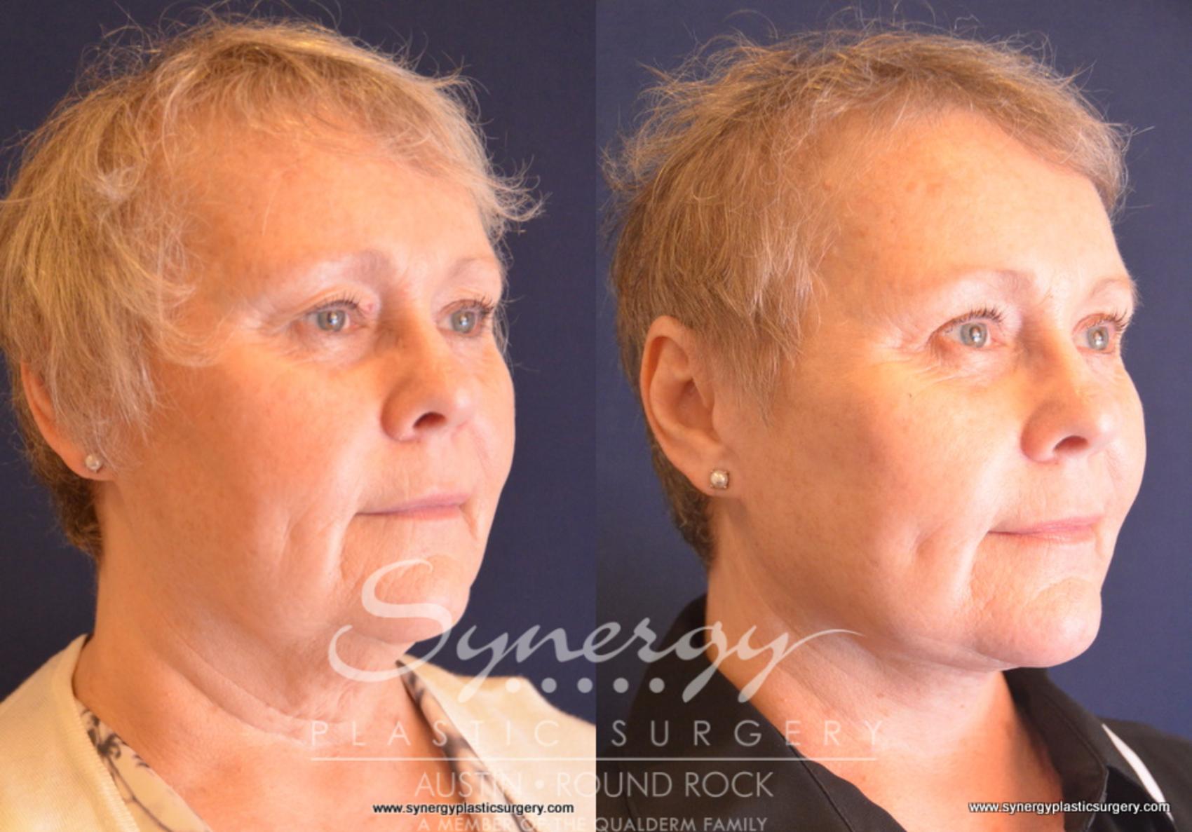 Before & After Facelift Case 688 View #5 View in Austin, TX
