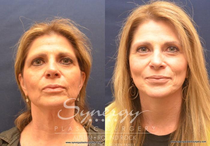 Before & After Facelift Case 743 View #1 View in Austin, TX