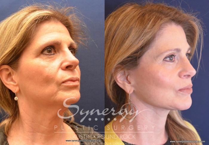 Before & After Facelift Case 743 View #2 View in Austin, TX