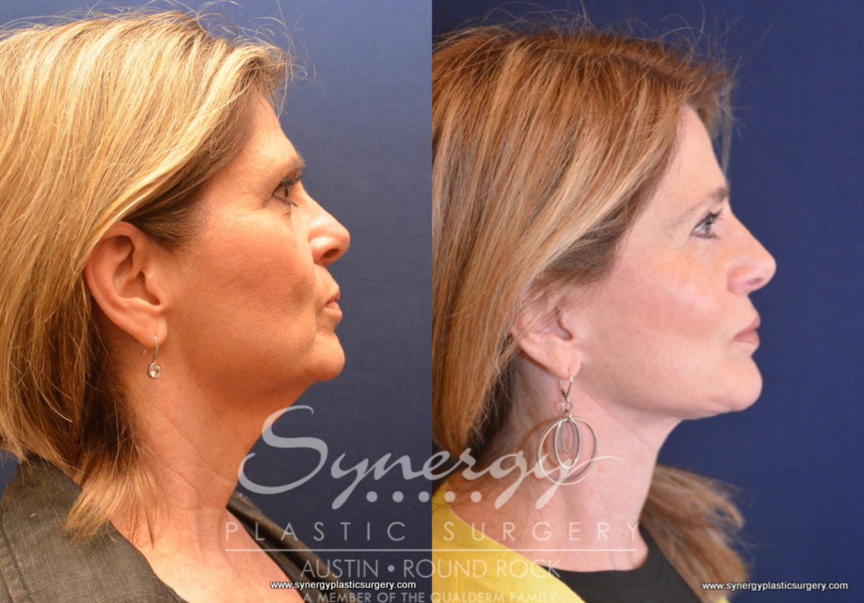Before & After Facelift Case 743 View #3 View in Austin, TX