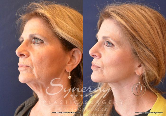 Before & After Facelift Case 743 View #4 View in Austin, TX