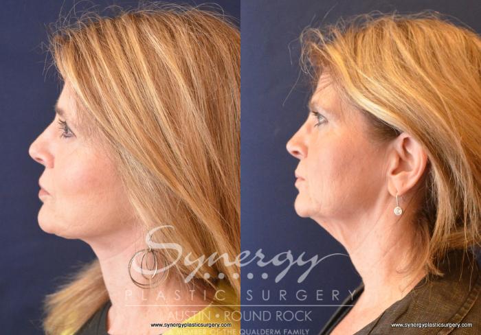 Before & After Facelift Case 743 View #5 View in Austin, TX
