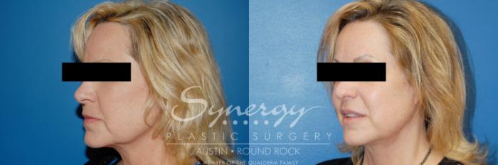 Before & After Facelift Case 9 View #2 View in Austin, TX