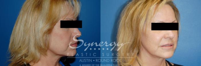 Before & After Facelift Case 9 View #3 View in Austin, TX