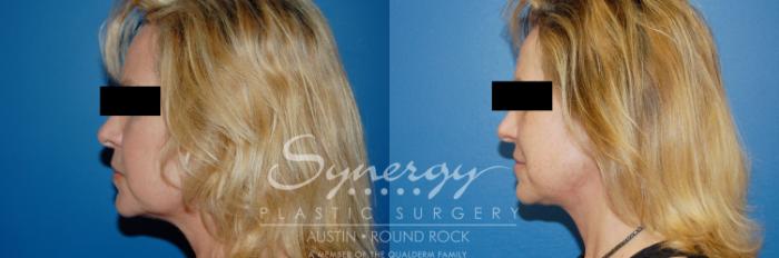 Before & After Facelift Case 9 View #4 View in Austin, TX
