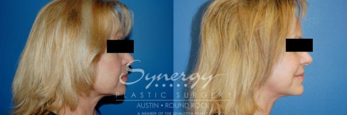 Before & After Facelift Case 9 View #5 View in Austin, TX