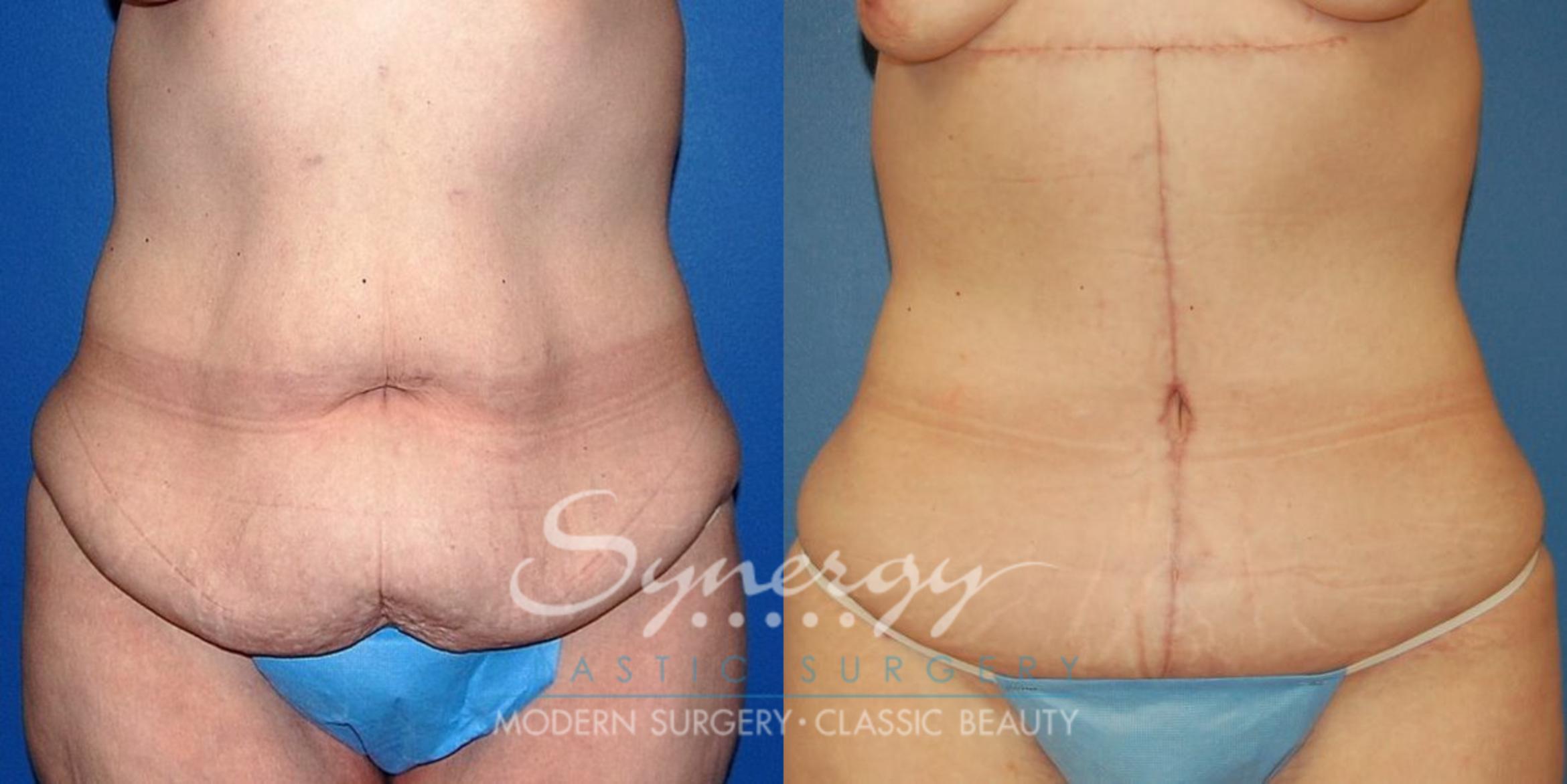 Before & After Fleur-de-Lis Abdominoplasty Case 23 View #1 View in Round Rock, TX