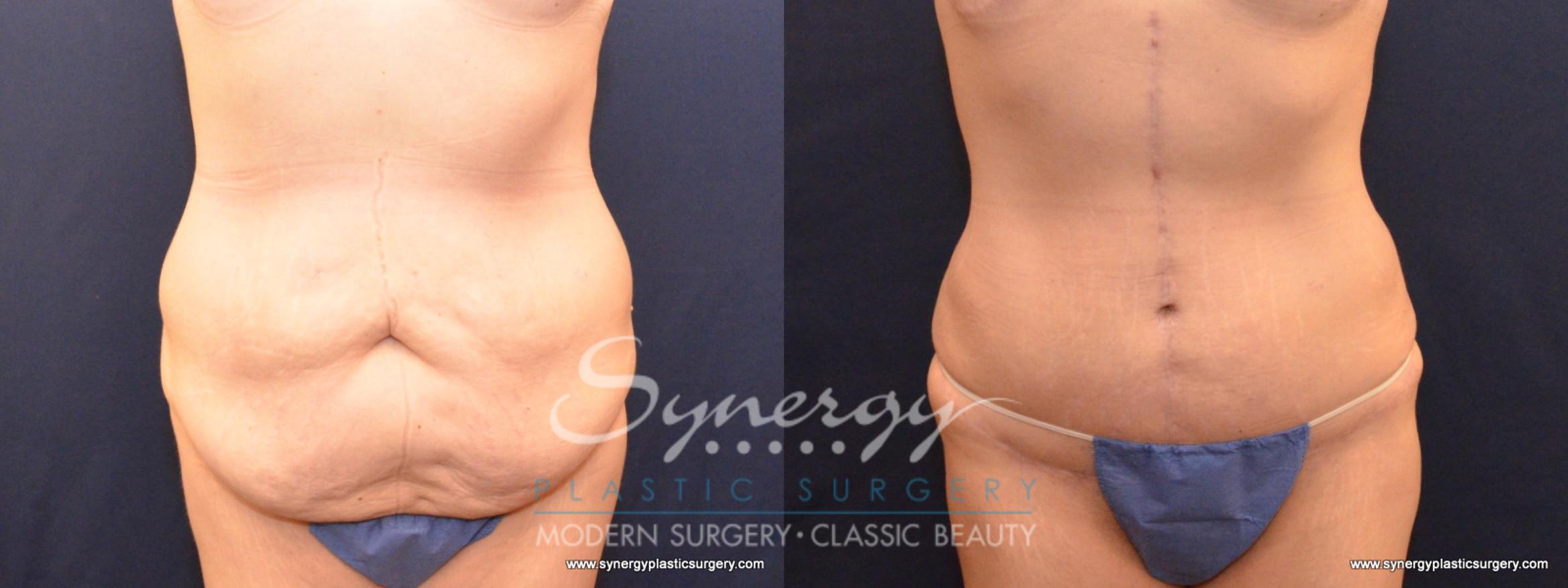 Before & After Fleur-de-Lis Abdominoplasty Case 570 View #1 View in Round Rock, TX