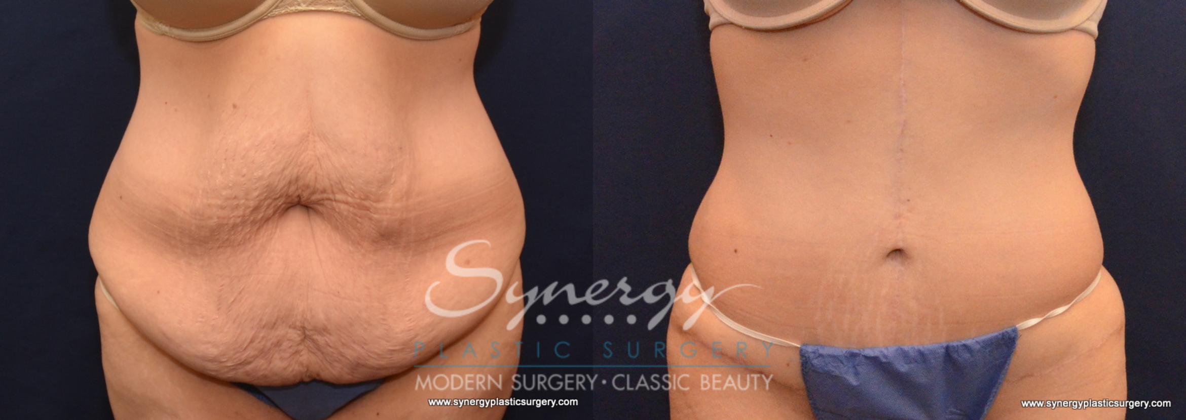 Before & After Fleur-de-Lis Abdominoplasty Case 612 View #1 View in Round Rock, TX