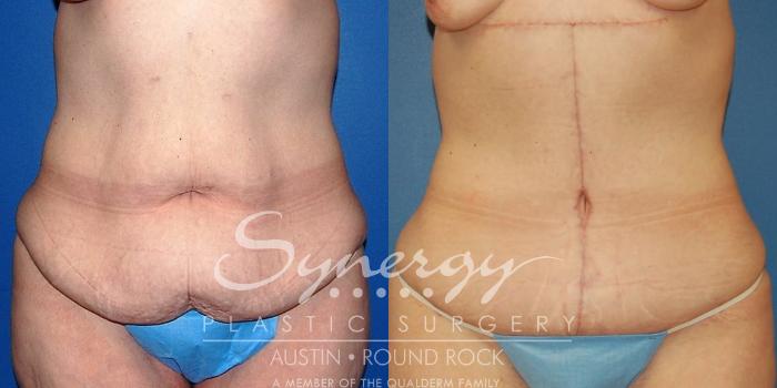 Before & After Fleur-de-Lis Tummy Tuck Case 23 View #1 View in Austin, TX