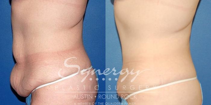 Before & After Fleur-de-Lis Tummy Tuck Case 23 View #2 View in Austin, TX