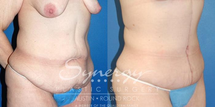 Before & After Fleur-de-Lis Tummy Tuck Case 23 View #3 View in Austin, TX