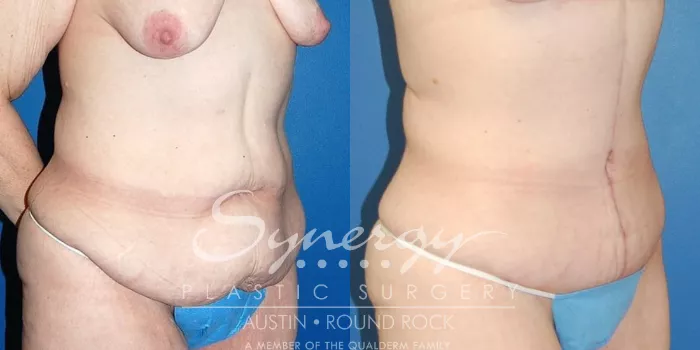 Before & After Fleur-de-Lis Tummy Tuck