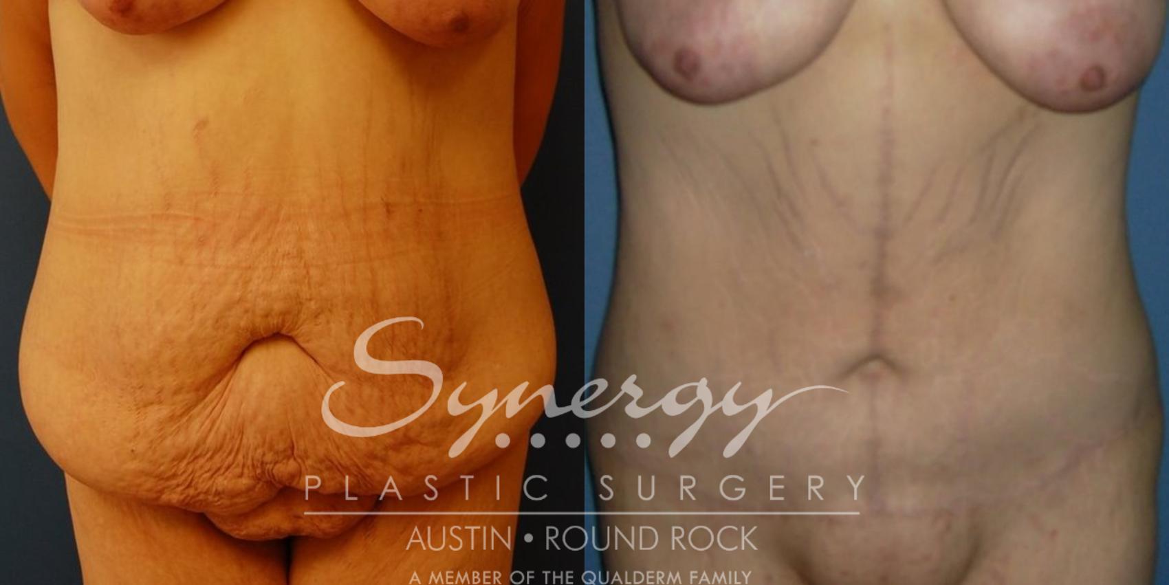 Before & After Abdominoplasty (Tummy Tuck) Case 30 View #1 View in Austin, TX