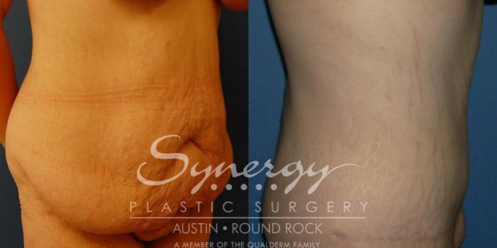 Before & After Abdominoplasty (Tummy Tuck) Case 30 View #2 View in Austin, TX