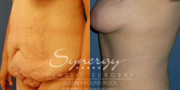 Before & After Abdominoplasty (Tummy Tuck) Case 30 View #3 View in Austin, TX