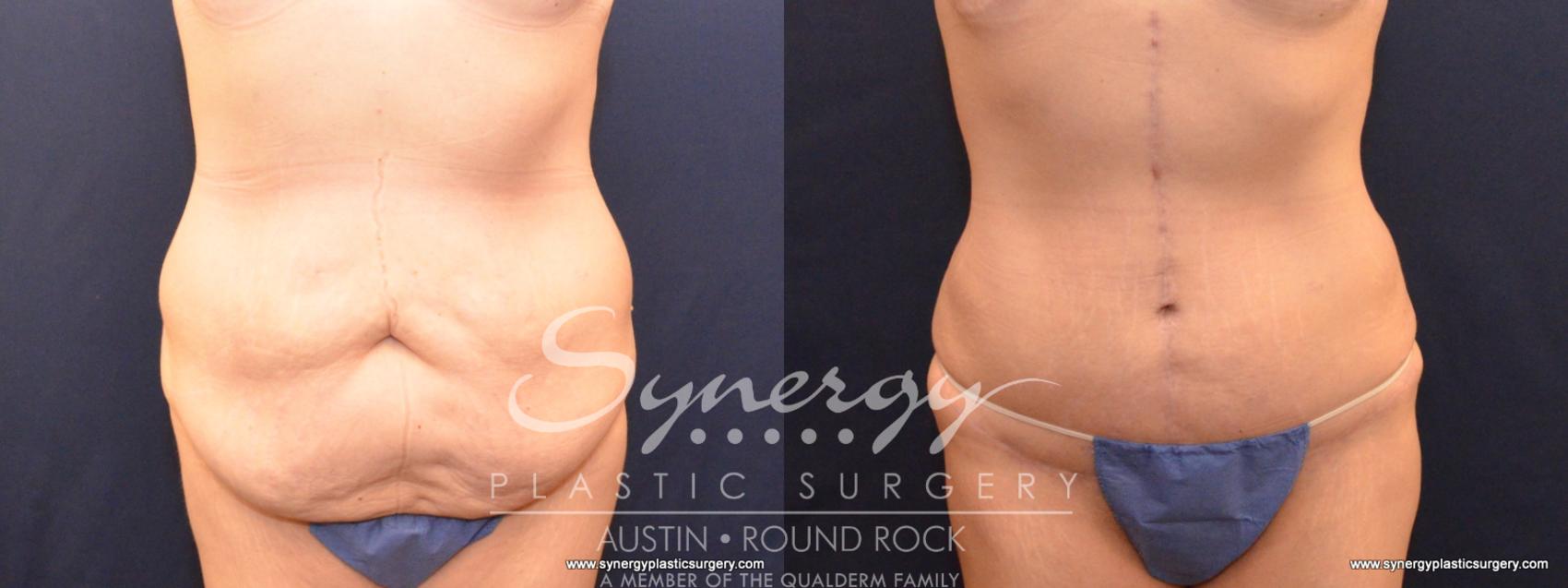 Before & After Fleur-de-Lis Tummy Tuck Case 570 View #1 View in Austin, TX